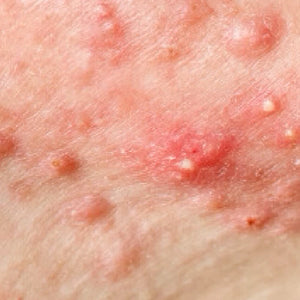 Bumps & blemishes